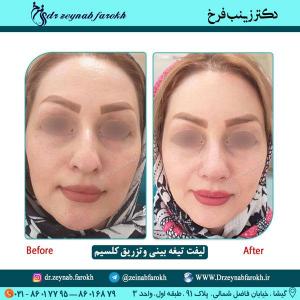 لیفت تیغه بینی و تزریق کلسیم 57
