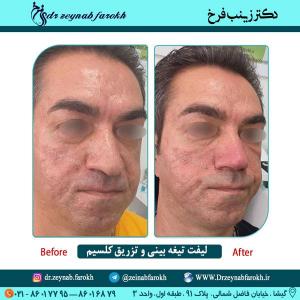 لیفت تیغه بینی و تزریق کلسیم 58
