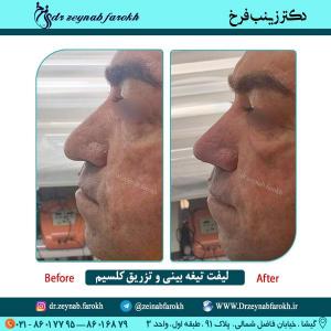 لیفت تیغه بینی و تزریق کلسیم 59