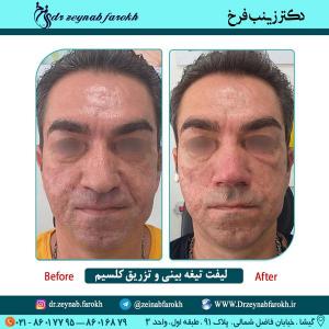 لیفت تیغه بینی و تزریق کلسیم 60