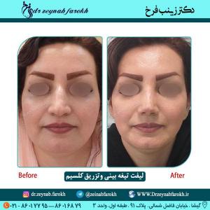 لیفت تیغه بینی و تزریق کلسیم 61