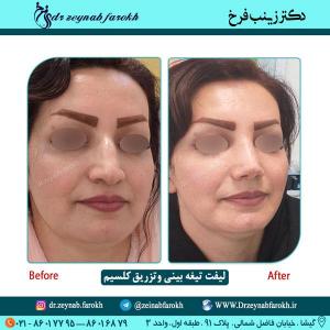 لیفت تیغه بینی و تزریق کلسیم 62