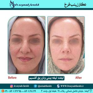 لیفت تیغه بینی و تزریق کلسیم 64
