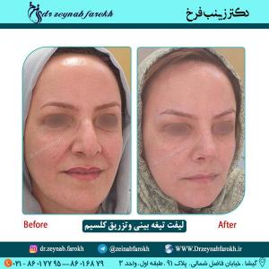 لیفت تیغه بینی و تزریق کلسیم 65