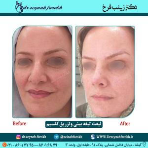 لیفت تیغه بینی و تزریق کلسیم 66