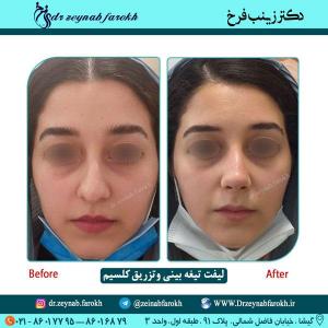 لیفت تیغه بینی و تزریق کلسیم 67
