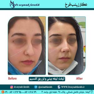 لیفت تیغه بینی و تزریق کلسیم 68