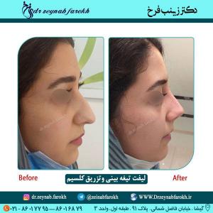 لیفت تیغه بینی و تزریق کلسیم 69