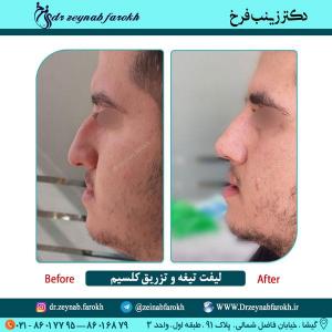 لیفت تیغه بینی و تزریق کلسیم در تهران 1