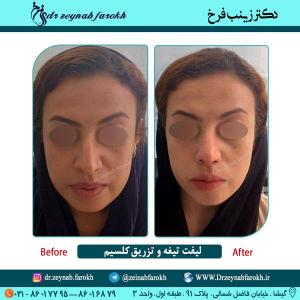 لیفت تیغه بینی و تزریق کلسیم در تهران 10