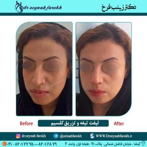 لیفت تیغه بینی و تزریق کلسیم در تهران 11