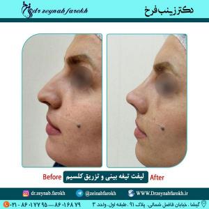 لیفت تیغه بینی و تزریق کلسیم در تهران 12