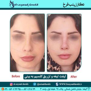 لیفت تیغه بینی و تزریق کلسیم در تهران 13