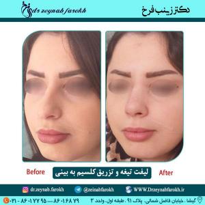 لیفت تیغه بینی و تزریق کلسیم در تهران 14