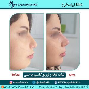 لیفت تیغه بینی و تزریق کلسیم در تهران 15