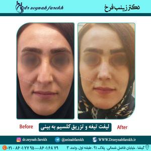 لیفت تیغه بینی و تزریق کلسیم در تهران 16