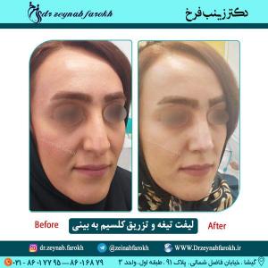 لیفت تیغه بینی و تزریق کلسیم در تهران 17
