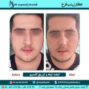 لیفت تیغه بینی و تزریق کلسیم در تهران 2
