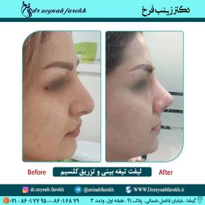 لیفت تیغه بینی و تزریق کلسیم در تهران 20