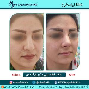 لیفت تیغه بینی و تزریق کلسیم در تهران 21
