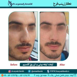 لیفت تیغه بینی و تزریق کلسیم در تهران 22
