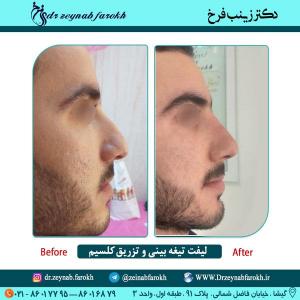 لیفت تیغه بینی و تزریق کلسیم در تهران 23