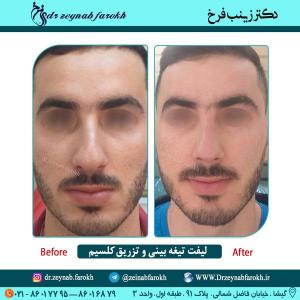 لیفت تیغه بینی و تزریق کلسیم در تهران 24