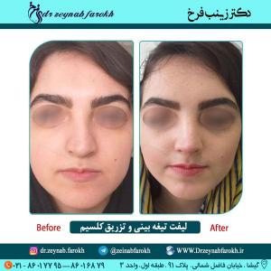 لیفت تیغه بینی و تزریق کلسیم در تهران 25