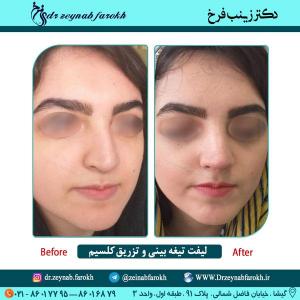 لیفت تیغه بینی و تزریق کلسیم در تهران 26