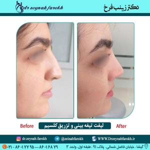 لیفت تیغه بینی و تزریق کلسیم در تهران 27