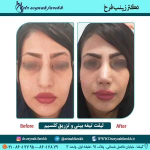 لیفت تیغه بینی و تزریق کلسیم در تهران 28