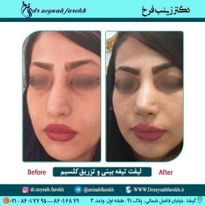 لیفت تیغه بینی و تزریق کلسیم در تهران 29