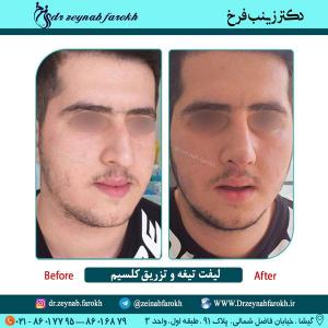 لیفت تیغه بینی و تزریق کلسیم در تهران 3