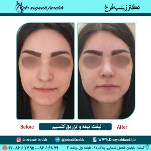 لیفت تیغه بینی و تزریق کلسیم در تهران 4