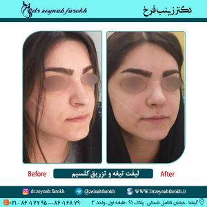 لیفت تیغه بینی و تزریق کلسیم در تهران 5