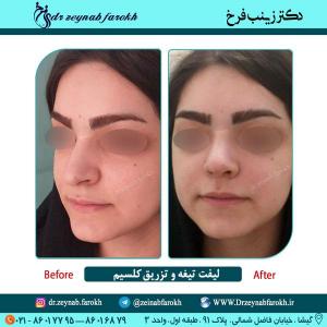 لیفت تیغه بینی و تزریق کلسیم در تهران 6