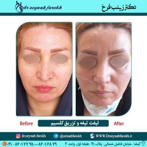 لیفت تیغه بینی و تزریق کلسیم در تهران 7