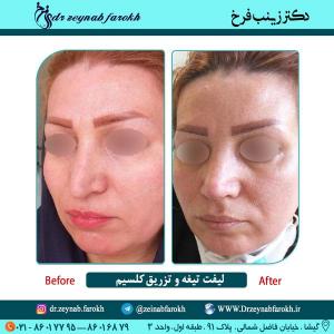 لیفت تیغه بینی و تزریق کلسیم در تهران 8