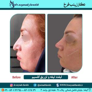 لیفت تیغه بینی و تزریق کلسیم در تهران 9