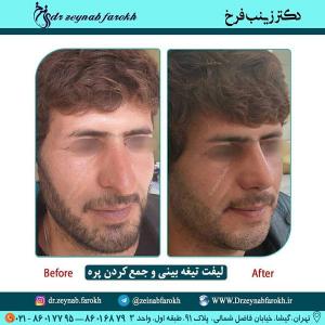 لیفت تیغه بینی و جمع کردن پره 336