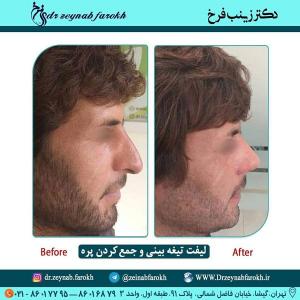 لیفت تیغه بینی و جمع کردن پره 337