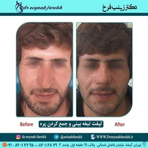 لیفت تیغه بینی و جمع کردن پره 338