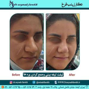 لیفت تیغه بینی و جمع کردن پره 345