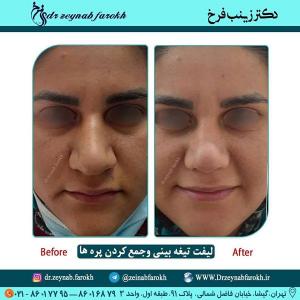 لیفت تیغه بینی و جمع کردن پره 346 (1)