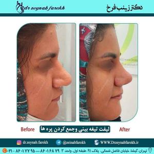 لیفت تیغه بینی و جمع کردن پره 347