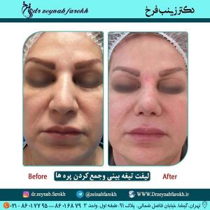لیفت تیغه بینی و جمع کردن پره 348