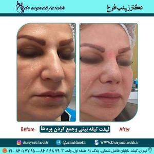 لیفت تیغه بینی و جمع کردن پره 349