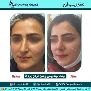 لیفت تیغه بینی و جمع کردن پره ها 358