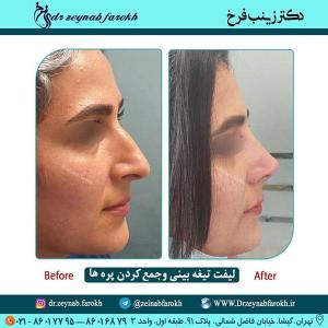 لیفت تیغه بینی و جمع کردن پره ها 359