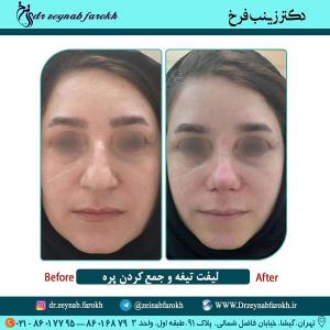 لیفت تیغه و  جمع کردن پره بینی 309